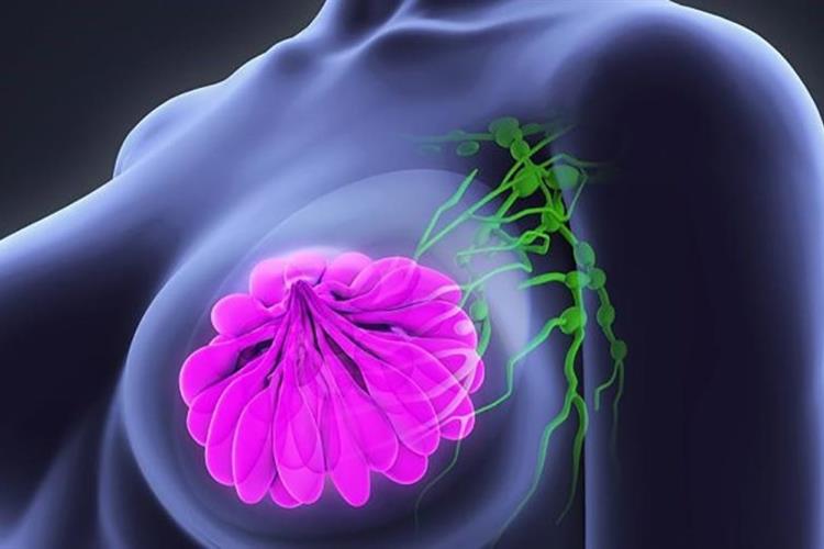 درمان سرطان سینه با طب سنتی
